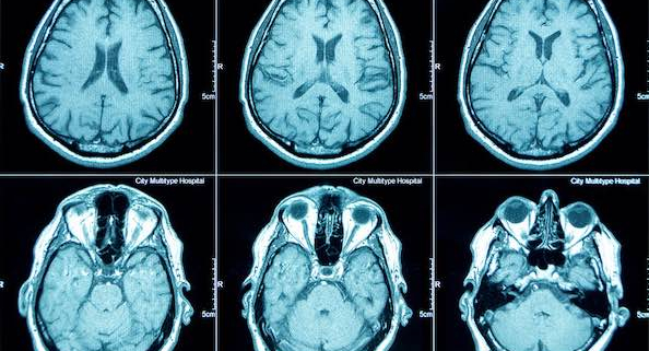 Brain Scan