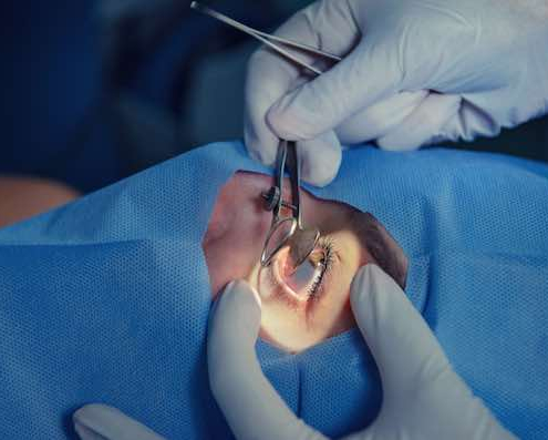 Cataract
