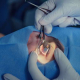 Cataract