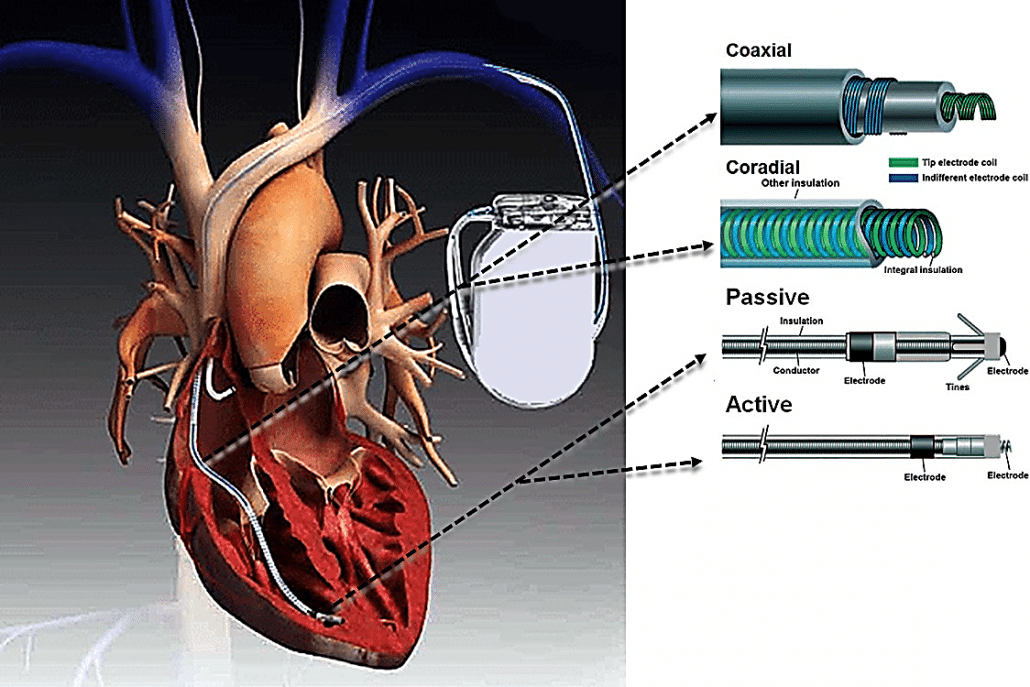 Heart Pacemaker Design The Evolution of the Pacemaker: A Conversation with Cardiologist Dr ...
